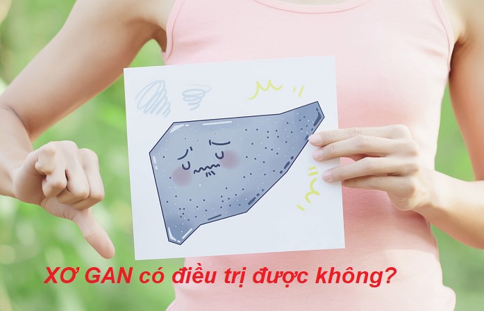 Xơ gan có chữa được không? Điều trị xơ gan